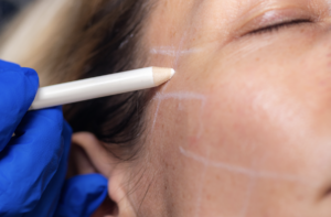 hilos pdo doctor marcando a paciente tratamiento clinica estetica taccone santiago chile