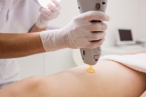 Close up of doctor performing laser hair removal on female patient skin in clinic