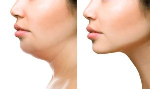 liposuccion hd de papada