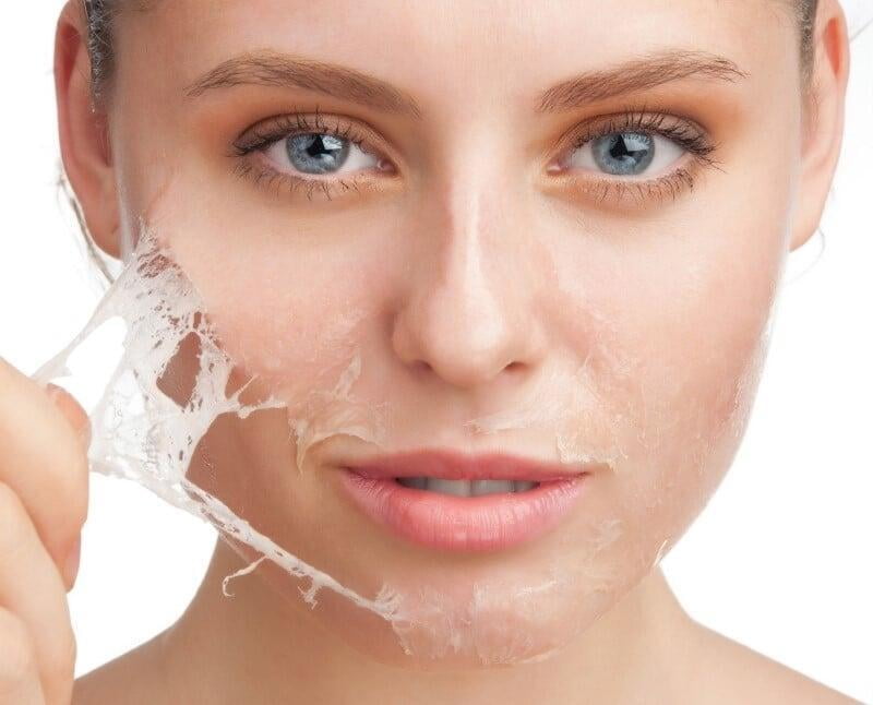 peeling quimico
