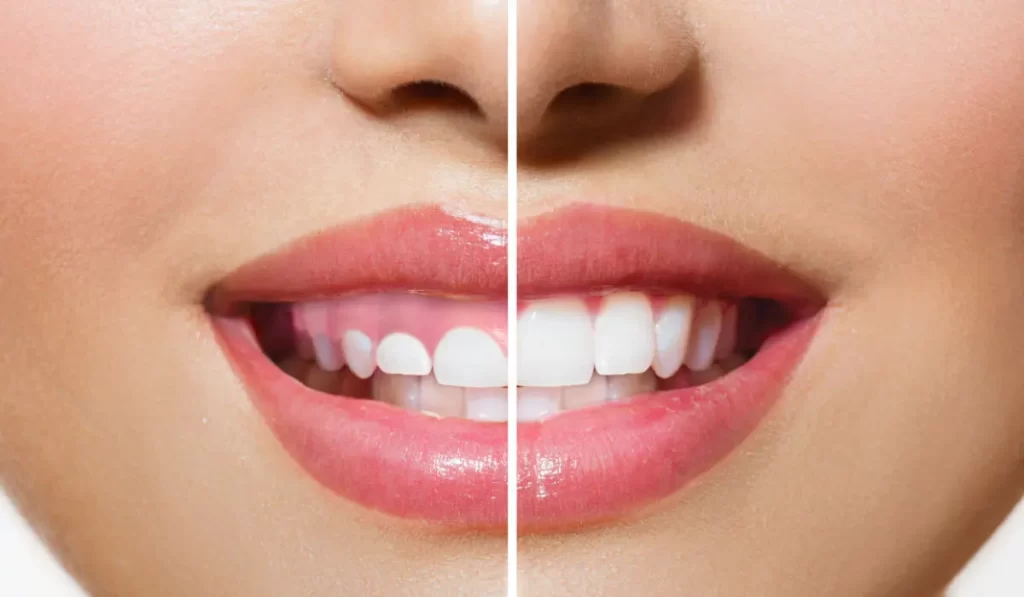 sonrisa gingival