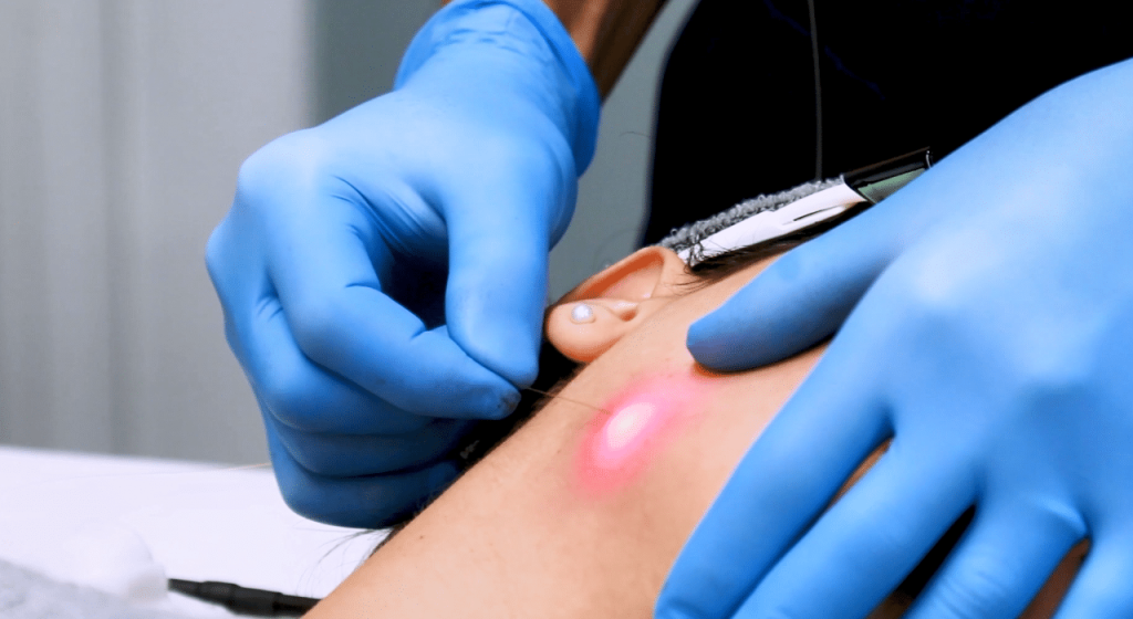 endolifting y lipo láser clínica medicina estética taccone santiago chile