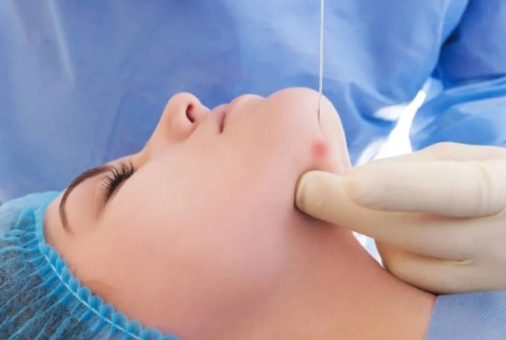 Rejuvenece tu Rostro con Innovadora Técnica: Endolifting Facial