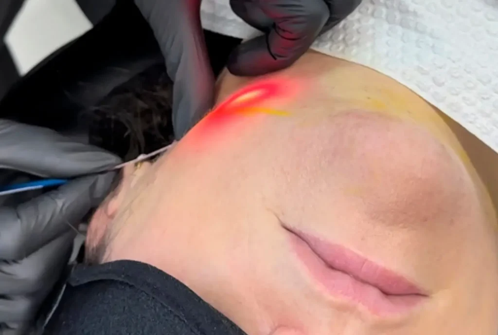 Endolaser Facial: La Revolución Estética para Eliminar la Papada